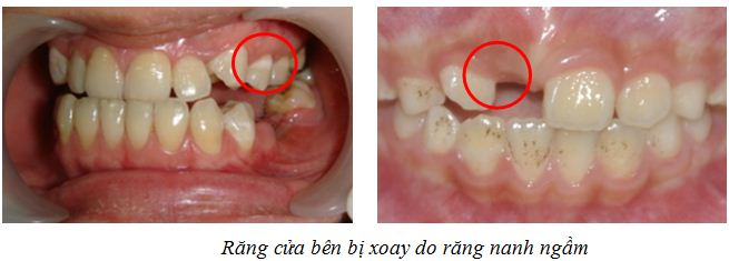 Răng mọc ngầm: Nguyên nhân, triệu chứng và cách điều trị hiệu quả