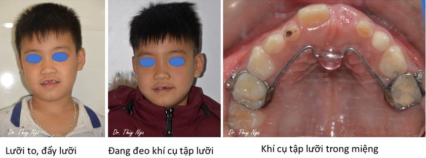 Thói quen xấu đẩy lưỡi gây móm và khí cụ tập lưỡi