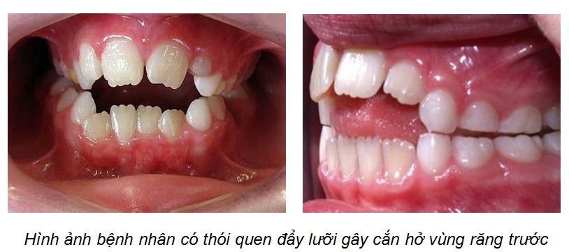 THÓI QUEN XẤU GÂY LỆCH LẠC RĂNG