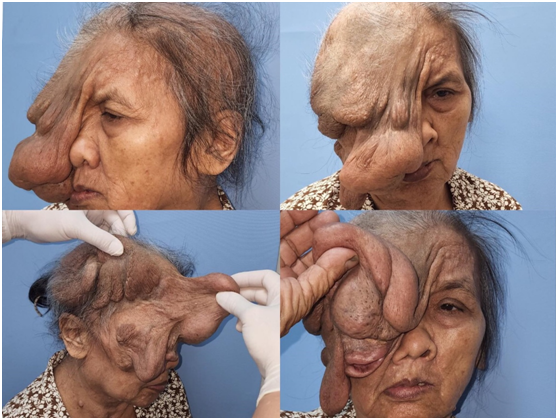 Khối u lớn trên khuôn mặt của bệnh nhân, trong ảnh ở đây, đã được các bác sĩ phẫu thuật NHOS loại bỏ thành công. (Ảnh: NHOS)
