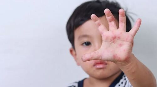 Vì sao bệnh tay chân miệng tăng mạnh ở trẻ mầm non vào đầu tuần?